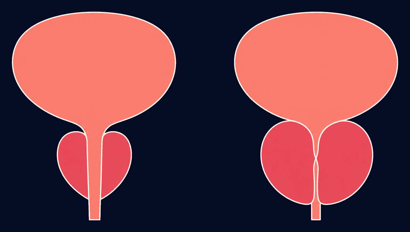 Schema anatomico: prostata normale e prostata ingrossata che comprime l’uretra